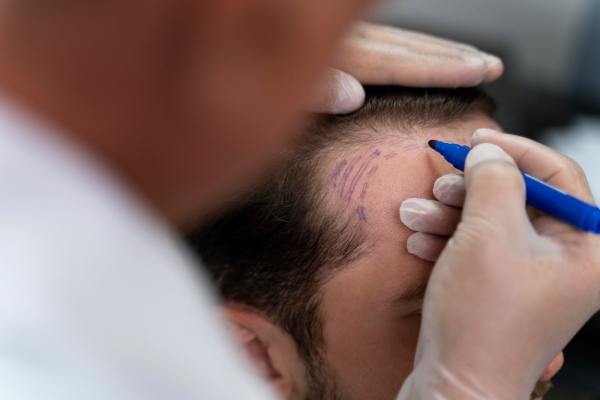 Homem sendo preparado para um implante de cabelo